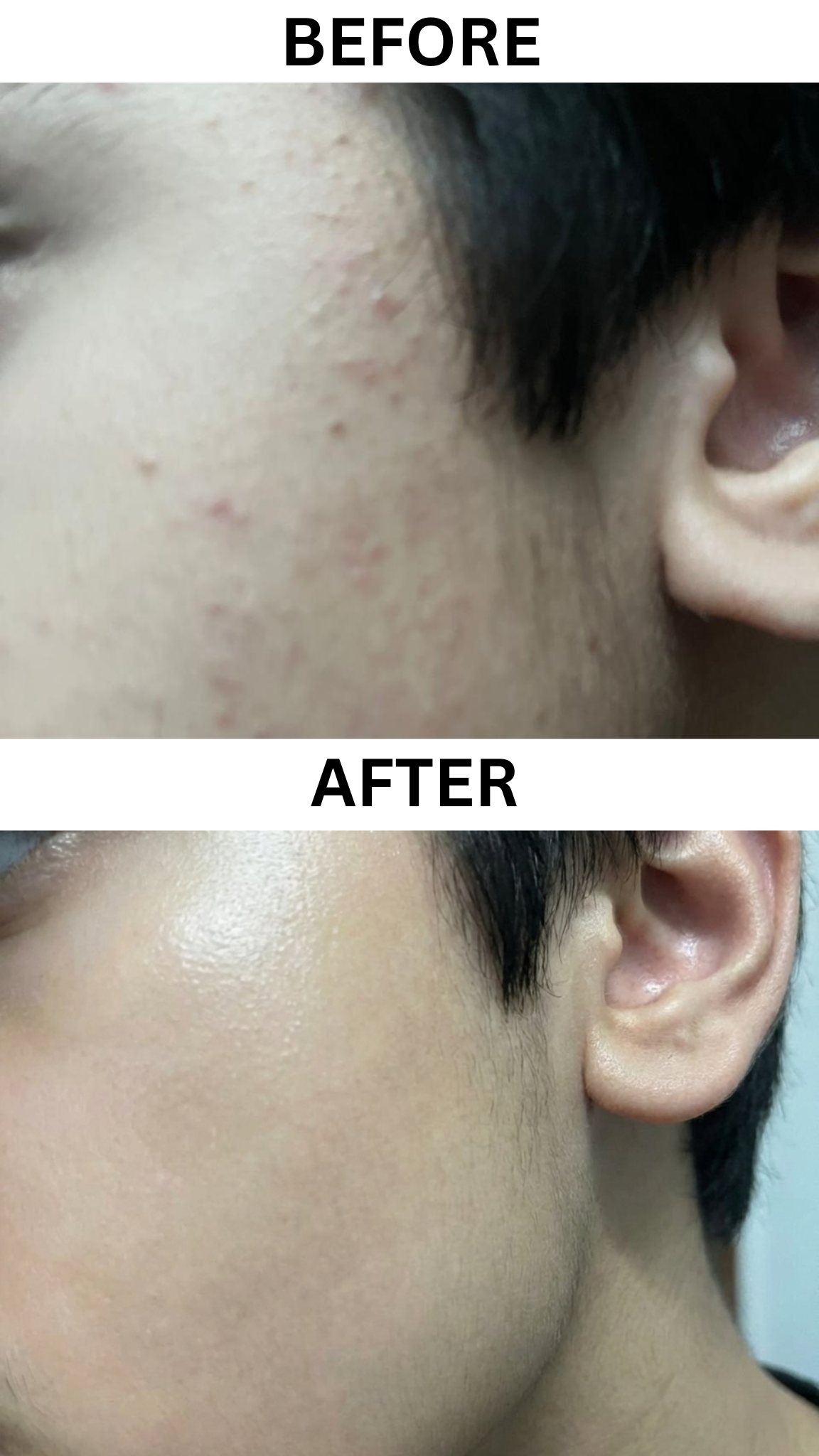 Clarix Ultimate Glow Kit - Kojic Acid Soap + Homeo Anti-Acne Soap
